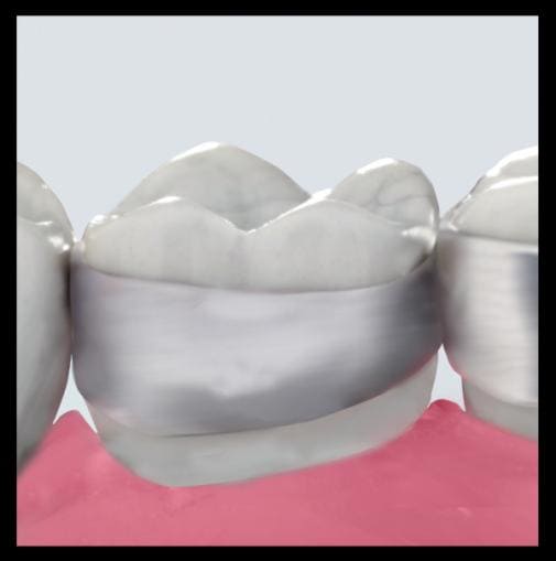 MOLAR BAND  NARROW REG L LT/RT MOLAR 34+